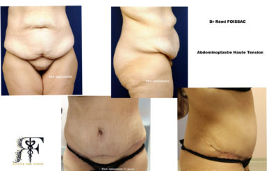Abdominoplastie un