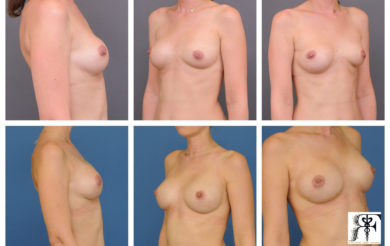 Chirurgie de changement de protheses mammaires