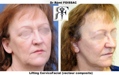 LCF 6.2