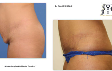 abdominoplastie deux profil