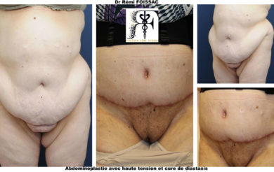 abdominoplastie trois