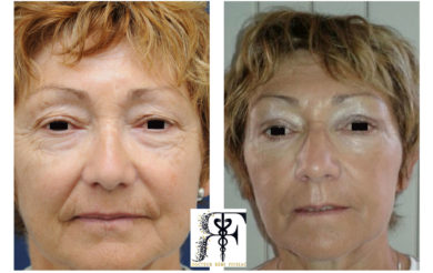 chirurgie paupiere copy