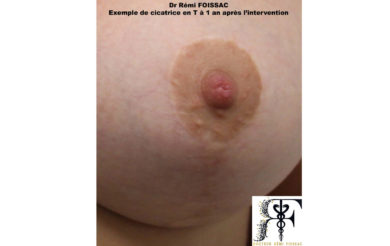 cicatrice en T