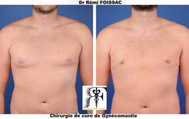gynecomastie face