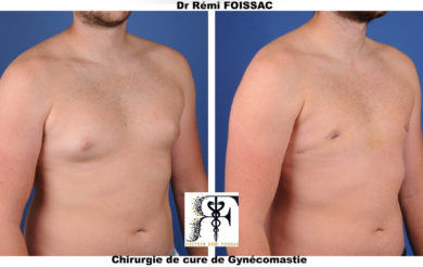gynecomastie trois quart