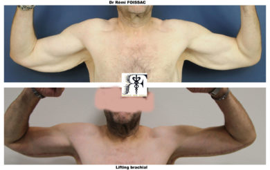 lifting bras deux