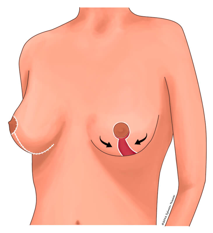 La chirurgie de lifting du sein ou cure de ptose
