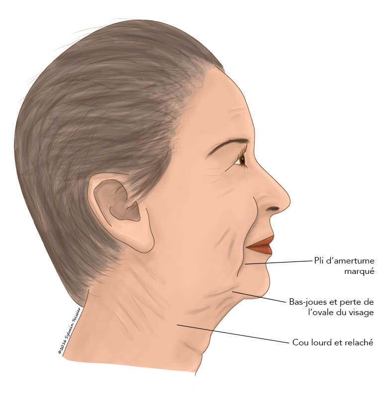 La chirurgie de lifting cervico-facial