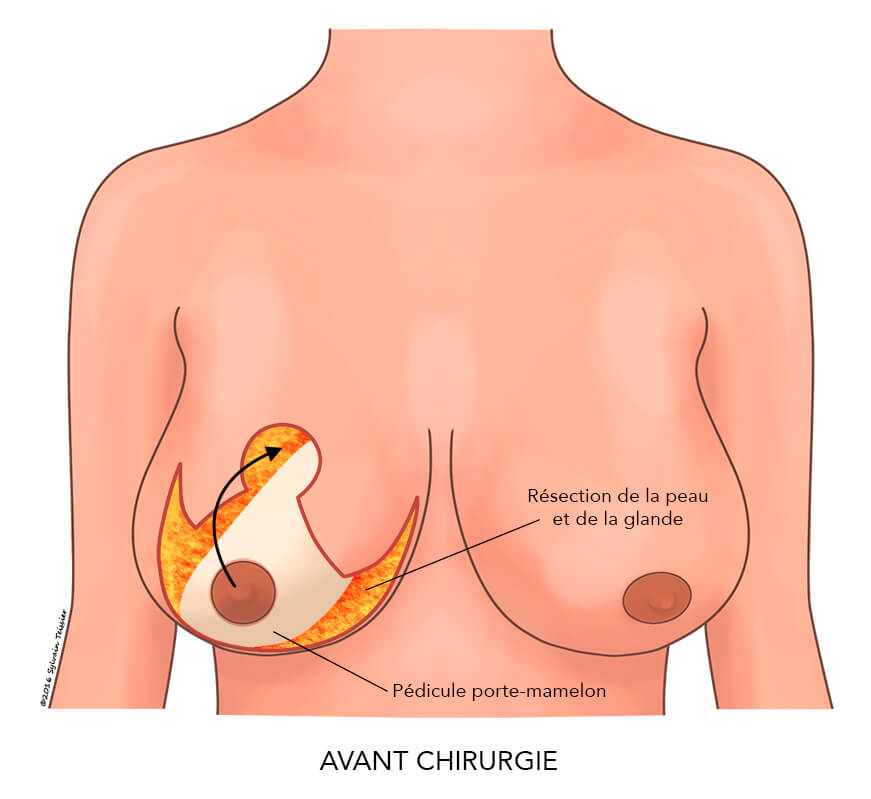 La chirurgie de réduction mammaire