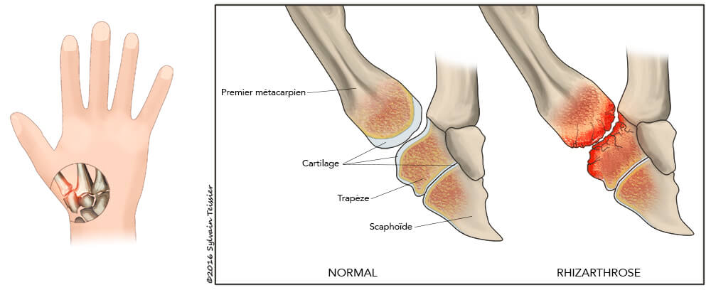 L'arthrose du pouce ou rizarthrose