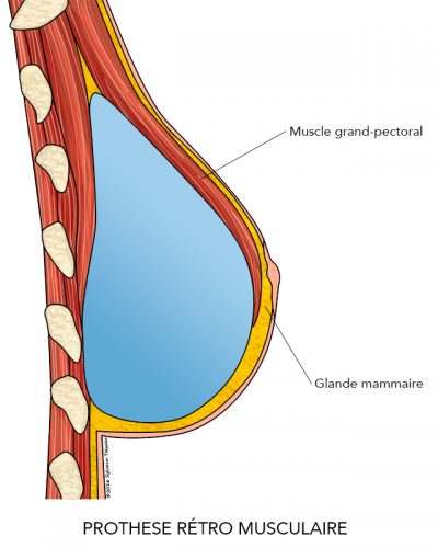 03-AugmentationMammaire3