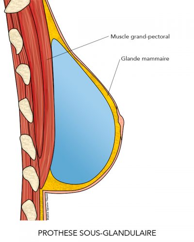 03-AugmentationMammaire4