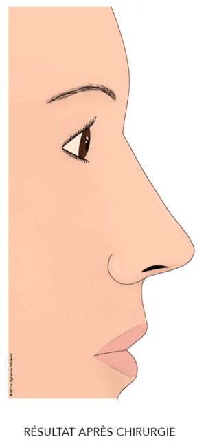 03-Rhinoplastie2