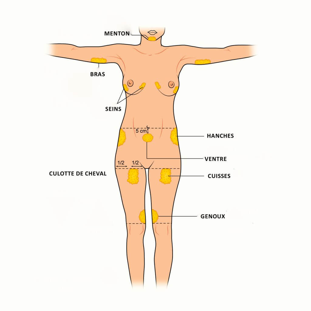 La chirurgie de lipostructure des seins