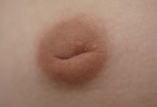 La chirurgie des mamelons invaginés/ombiliqués