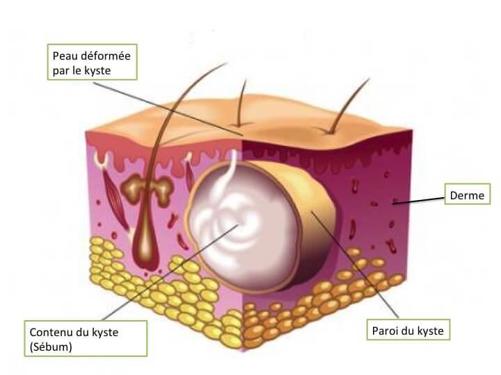 La chirurgie des kystes