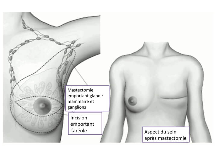 La chirurgie reconstructrice du sein après cancer