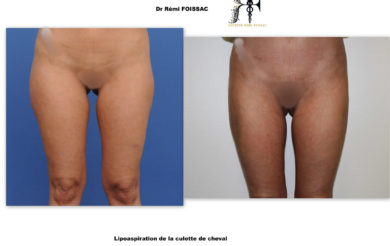 Lipoaspi face