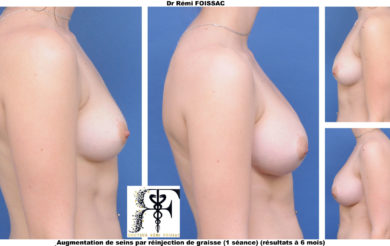 Lipofilling sein 1.1