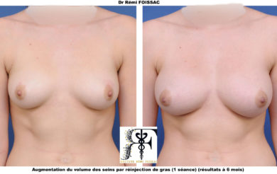 Lipofilling sein 1.3