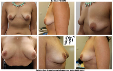 Lipofilling sein 2