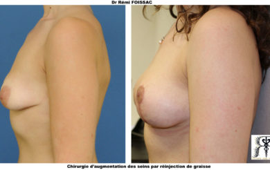 Lipofilling sein 3.1