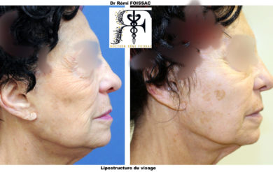 Lipostructure visage