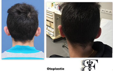 Otoplastie postérieur