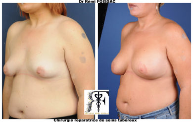 Seins tubéreux 1