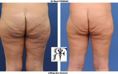 lifting cuisse deux