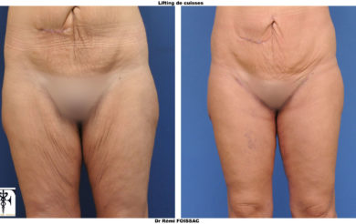 lifting cuisses