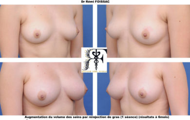 lipofilling sein 1.2