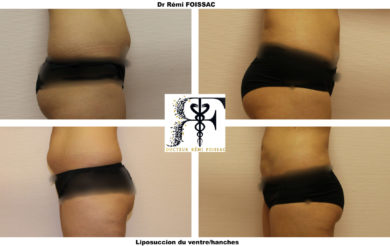 liposuccion ventre