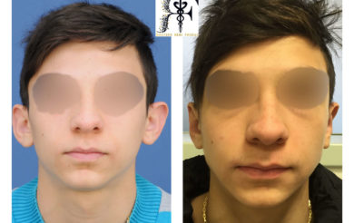 otoplastie face