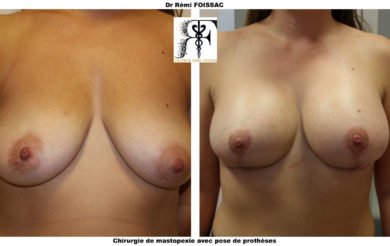 pexie prothèses de face