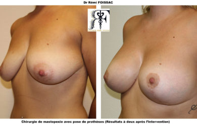 pexie prothèses trois quart