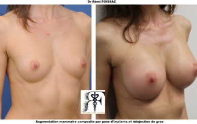 protheses mammaires composites trois quart