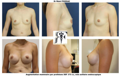 protheses mammaires endoscopiques 2