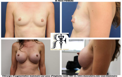 protheses mammaires grain de beauté 2