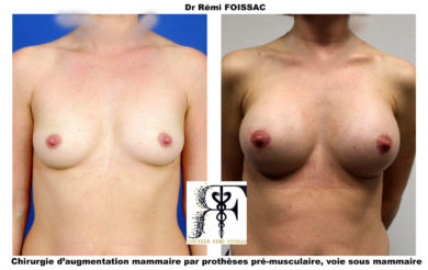 protheses premusface2