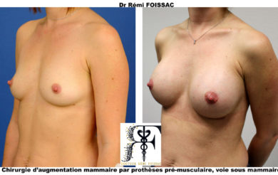 protheses premustroisquart