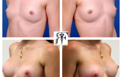 prothèses endoscopiques 1