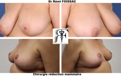 reduction mammaire 5