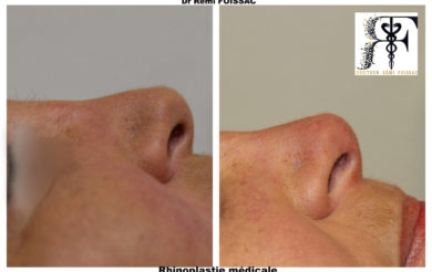 rhinoplastie médicale 2