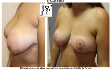 seins tubereux 3