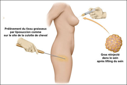 La chirurgie de cure de ptose du sein associé à la pose d’implant mammaire ou de réinjection de gras