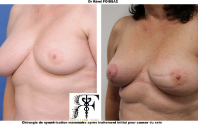 symétrisation mammaire